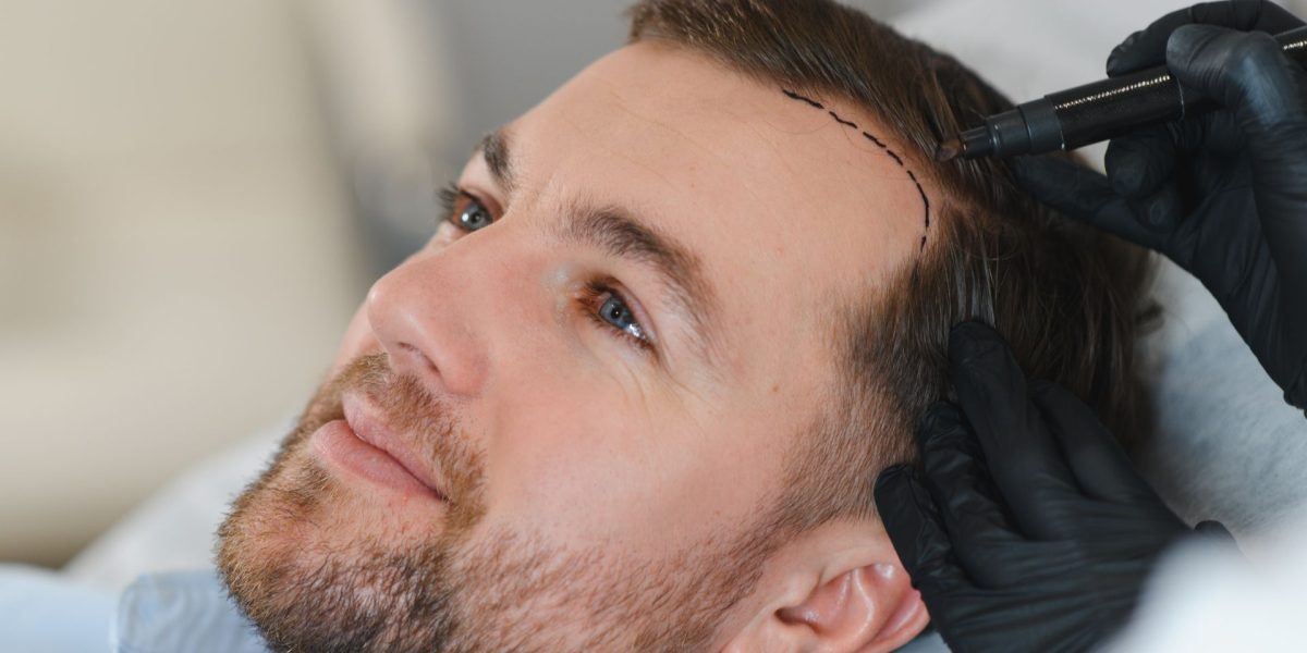 Cercetătorii au reușit pentru prima dată să cultive în laborator foliculi de păr complet funcționali, deschizând astfel calea spre o nouă frontieră în tratamentele pentru căderea părului