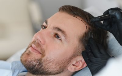 Cercetătorii au reușit pentru prima dată să cultive în laborator foliculi de păr complet funcționali, deschizând astfel calea spre o nouă frontieră în tratamentele pentru căderea părului