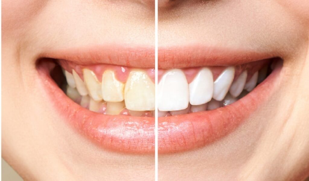 Aspectul dinților poate fi influențat de o varietate de factori ce duc la apariția nuanței galbene sau a petelor pe suprafața acestora