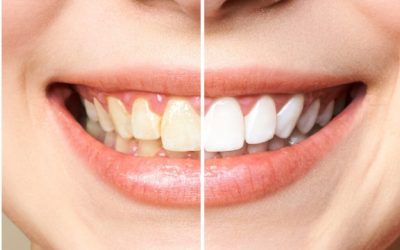 Aspectul dinților poate fi influențat de o varietate de factori ce duc la apariția nuanței galbene sau a petelor pe suprafața acestora