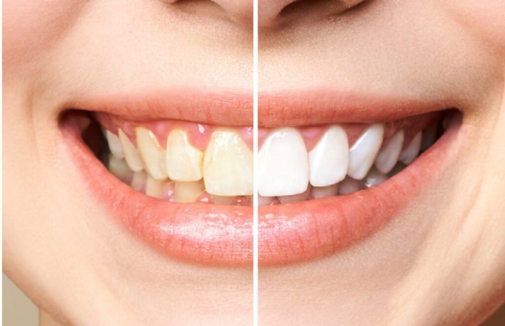 Aspectul dinților poate fi influențat de o varietate de factori ce duc la apariția nuanței galbene sau a petelor pe suprafața acestora