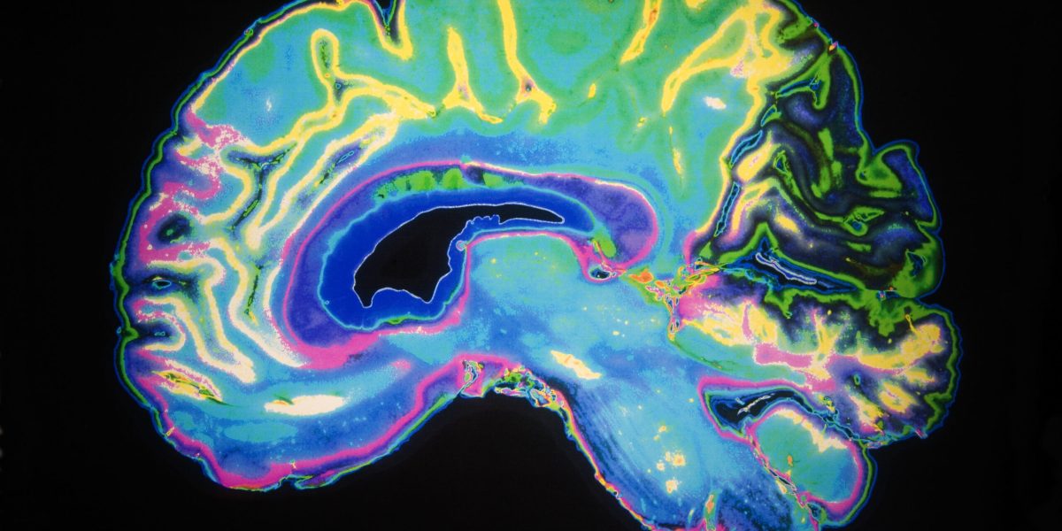 O descoperire revoluționară în cercetarea neurodegenerativă ar putea schimba abordarea tratamentelor pentru boala Alzheimer