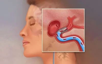 Un avertisment sănătos: semnele care pot indica prezența unui anevrism cerebral Un semnal de alarmă ar trebui să ne fie mereu în atenție: anumite simptome pot ascunde o afecțiune gravă, precum anevrismul cerebral, o problemă vasculară care, dacă nu este identificată și tratată la timp, poate avea consecințe fatale