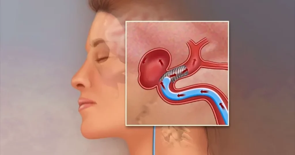 Un avertisment sănătos: semnele care pot indica prezența unui anevrism cerebral Un semnal de alarmă ar trebui să ne fie mereu în atenție: anumite simptome pot ascunde o afecțiune gravă, precum anevrismul cerebral, o problemă vasculară care, dacă nu este identificată și tratată la timp, poate avea consecințe fatale