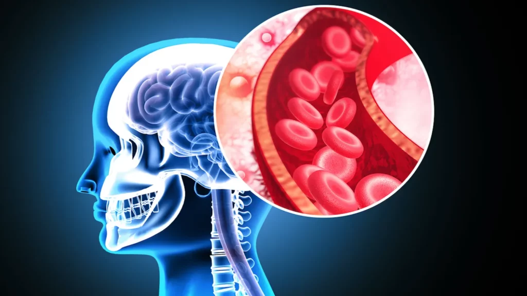 Un studiu extins realizat de cercetători de la Universitatea Cambridge a adus noi lumină asupra legăturii dintre consumul de droguri recreaționale și riscul de accident vascular cerebral (AVC)