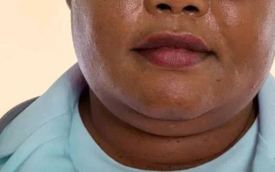 Bărbia dublă indică posibilă rezistență la insulină, nu doar estetică