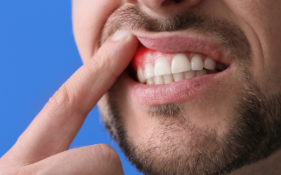 Gingiile sângeroase, respirația urât mirositoare și peliculă albicioasă pe limbă – simptome aparent simple ale problemelor orale – pot ascunde riscuri serioase pentru sănătate, inclusiv un potențial risc de cancer colorectal