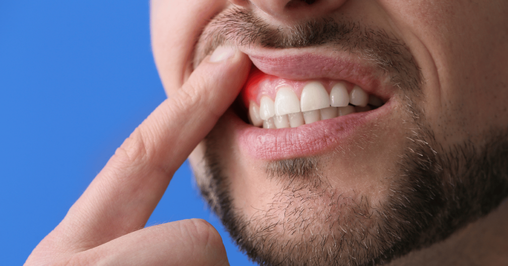 Gingiile sângeroase, respirația urât mirositoare și peliculă albicioasă pe limbă – simptome aparent simple ale problemelor orale – pot ascunde riscuri serioase pentru sănătate, inclusiv un potențial risc de cancer colorectal