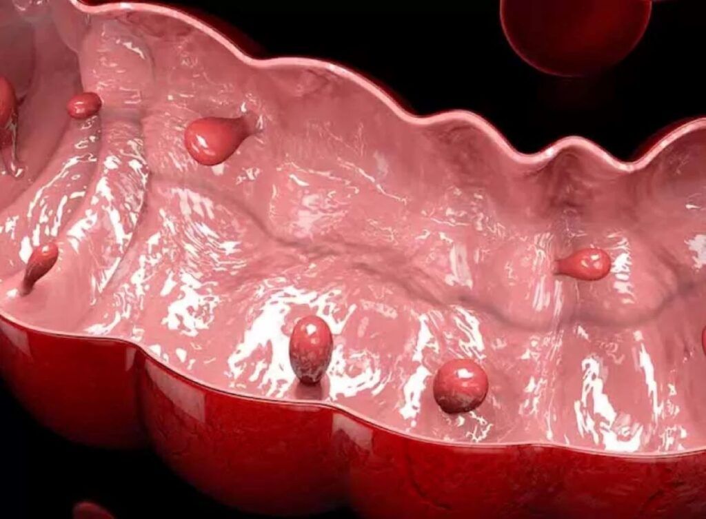 Polipii sesili din colon și rect pot fi, adesea, asimptomatici, însă prezintă un risc real de transformare malignă dacă nu sunt descoperiți în timp