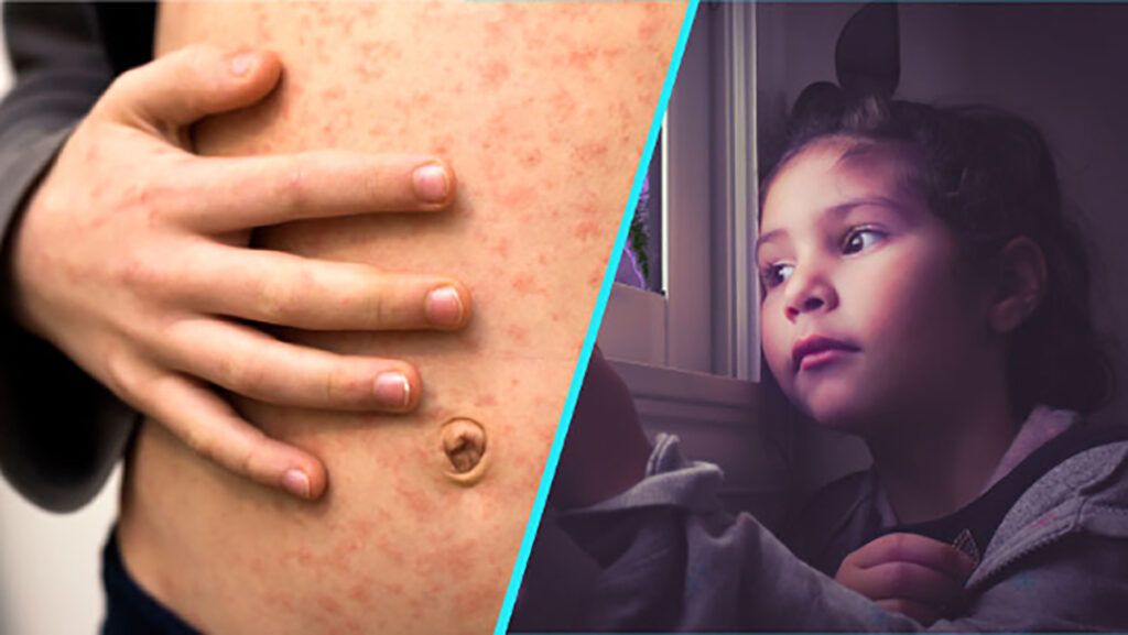Cazurile de rujeolă înregistrează o creștere alarmantă, iar 2026 riscă să devină unul dintre cei mai critici ani din istoria recentă a sănătății publice globale