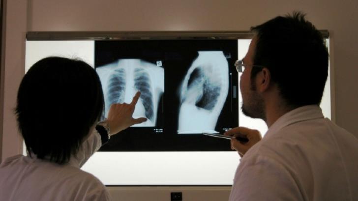 România continuă să se confrunte cu o problemă majoră de sănătate publică: incidența tuberculozei rămâne ridicată, situându-se în jurul valorii de 44,3 cazuri la o sută de mii de locuitori, conform datelor recente ale Institutului Național de Sănătate Publică