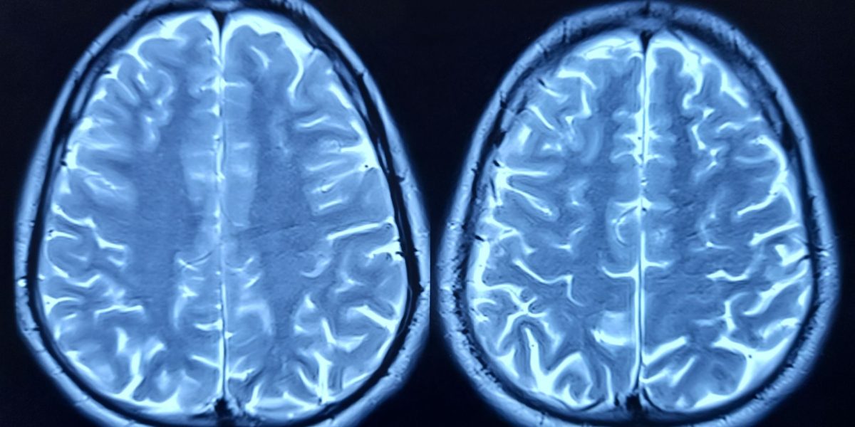 Cercetările arată ce factorilor accelerază îmbătrânirea creierului