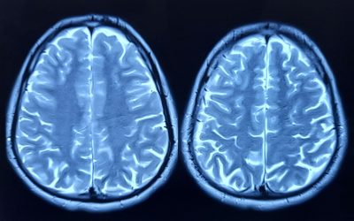 Cercetările arată ce factorilor accelerază îmbătrânirea creierului