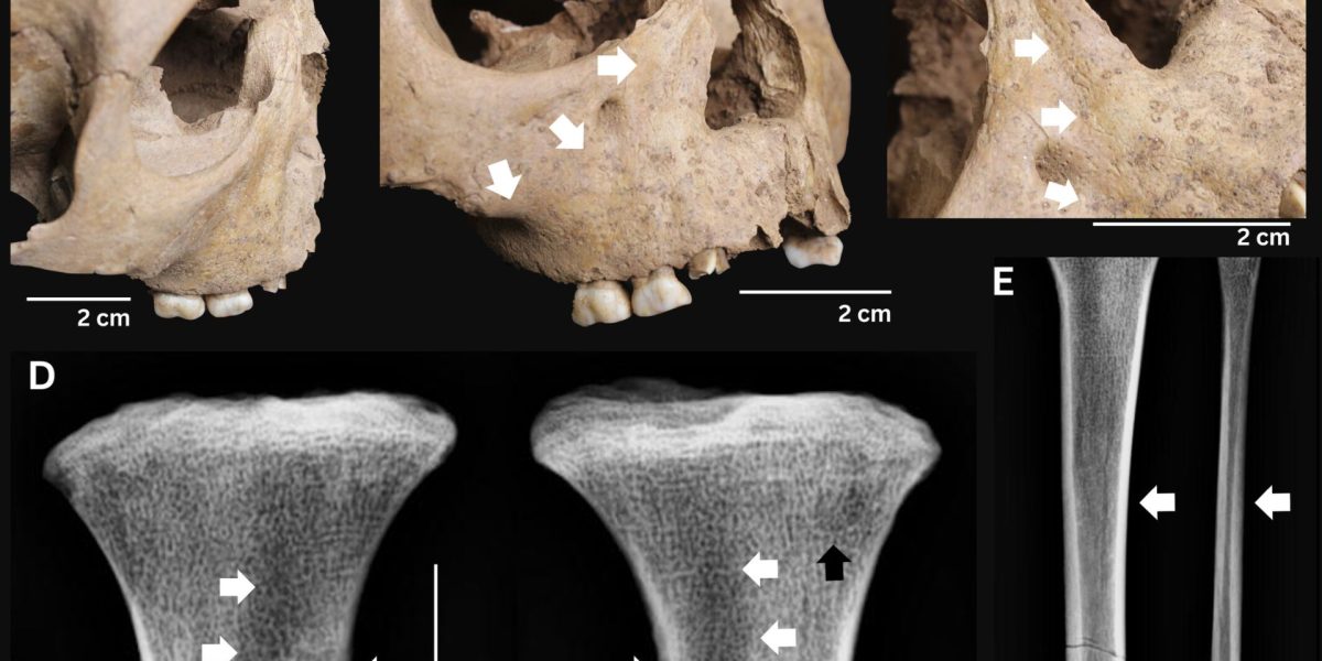 Dinții copiilor antic dezvăluie o boală gravă de acum 4.000 de ani