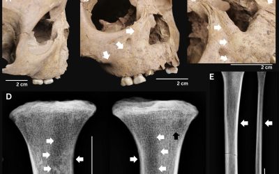 Dinții copiilor antic dezvăluie o boală gravă de acum 4.000 de ani