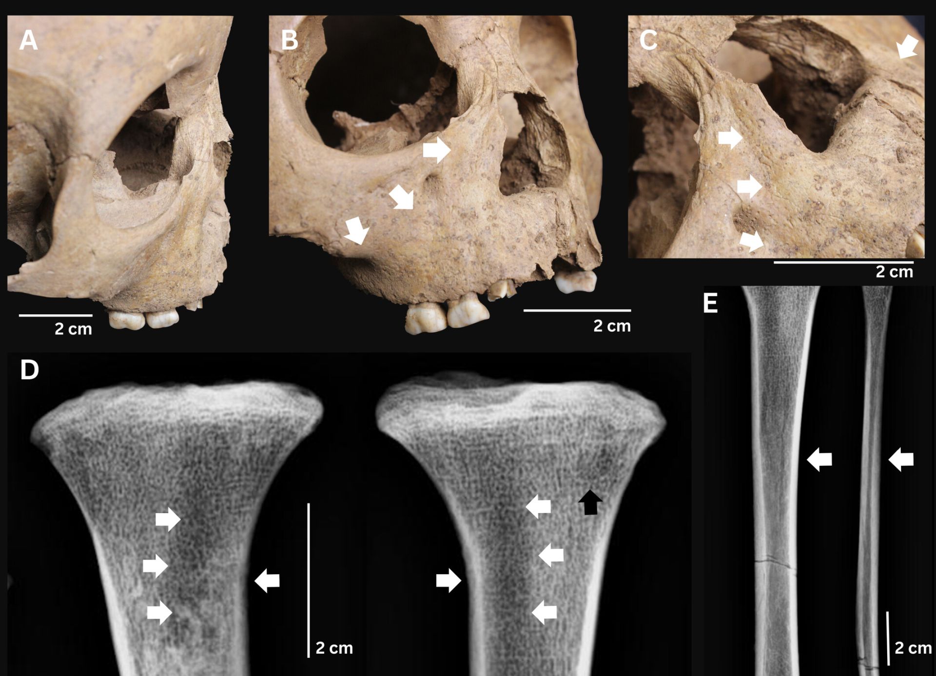 Cercetătorii au identificat urme ale unei boli bacteriene grave în dinții a trei copii antici din Vietnam, ceea ce poate schimba înțelesul actual despre originea sifilisului