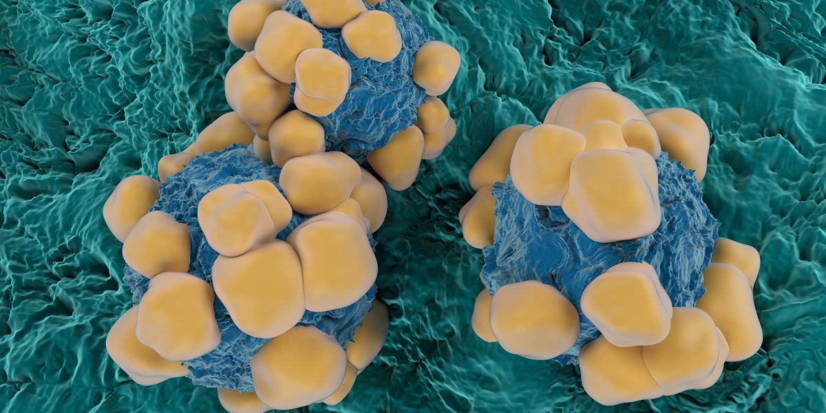 Oamenii de știință inventează senzori subțiri precum firul de păr pentru detectarea timpurie a cancerului