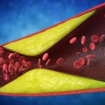 Arterele blocate: 7 semne vitale ignorate, avertizează cardiologii din România