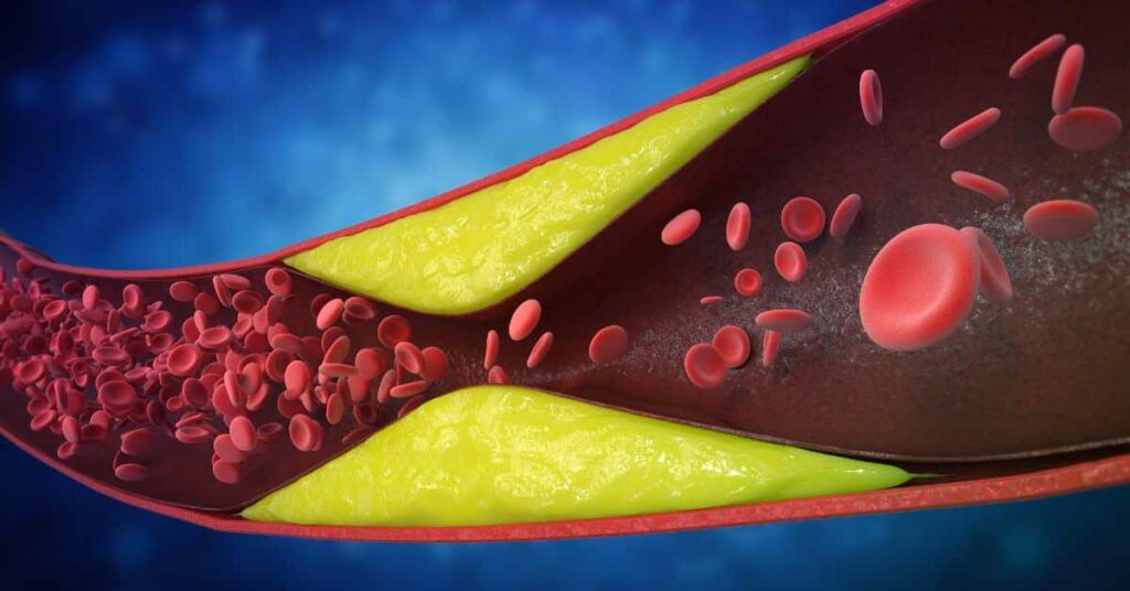Arterele blocate: 7 semne vitale ignorate, avertizează cardiologii din România