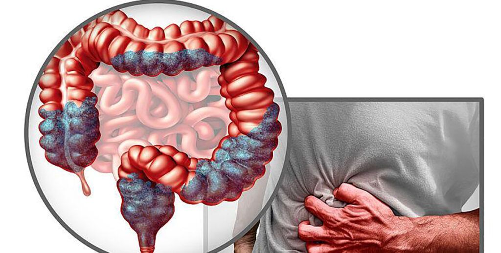 Aproape jumătate dintre adulți nu sunt conștienți de legătura directă dintre consumul anumitor alimente și riscul crescut de cancer colorectal