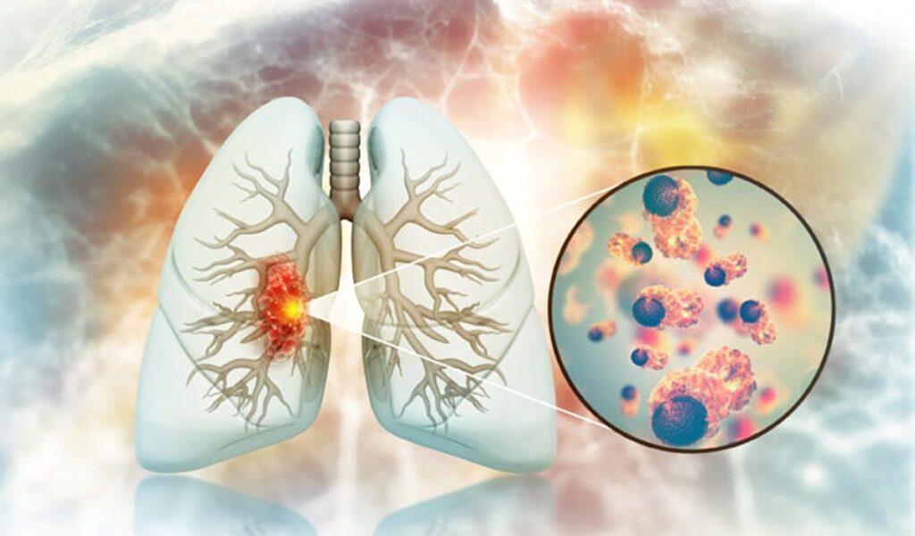 Creștere ȘOC în România: Cancer pulmonar la nefumători. Medicii, uimiți