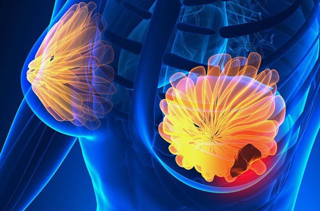 Top 5 simptome ale cancerului de sân: Fii atentă la aceste semne