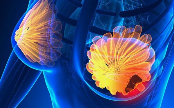 Top 5 simptome ale cancerului de sân: Fii atentă la aceste semne