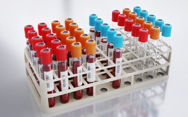 Analiză de sânge revoluționară: Prezice infarctul și AVC mai bine ca colesterolul