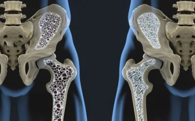 Nou tratament promite oase mai puternice și luptă cu osteoporoza