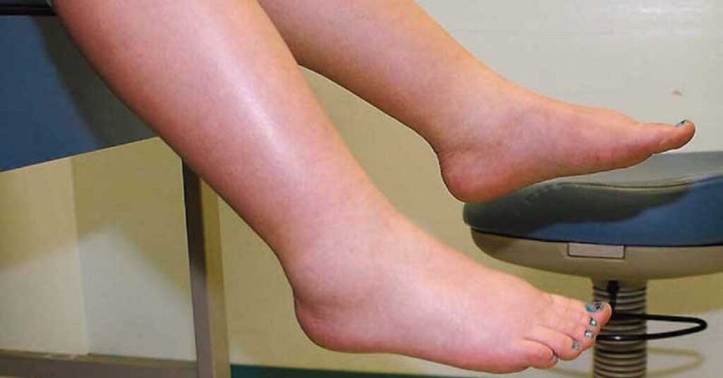 Leguma-minune: Scapă de picioare umflate și îmbunătățește circulația!