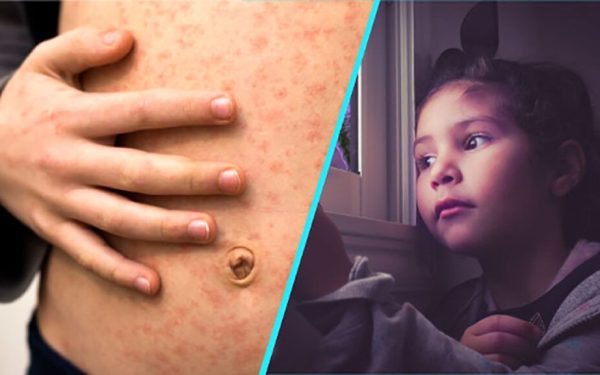 Rujeolă, gripă și vaccinare: Dr. Alexiu, despre dezastrul din România