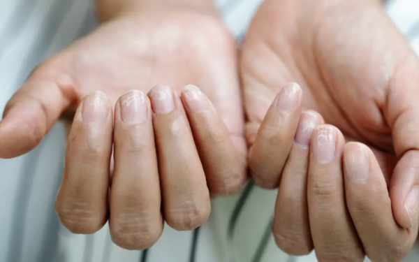 Unghiile Terry: Semnalul ascuns al bolilor grave. Ce boli indică