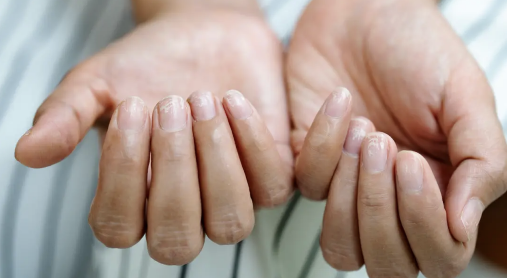 Unghiile Terry: Semnalul ascuns al bolilor grave. Ce boli indică