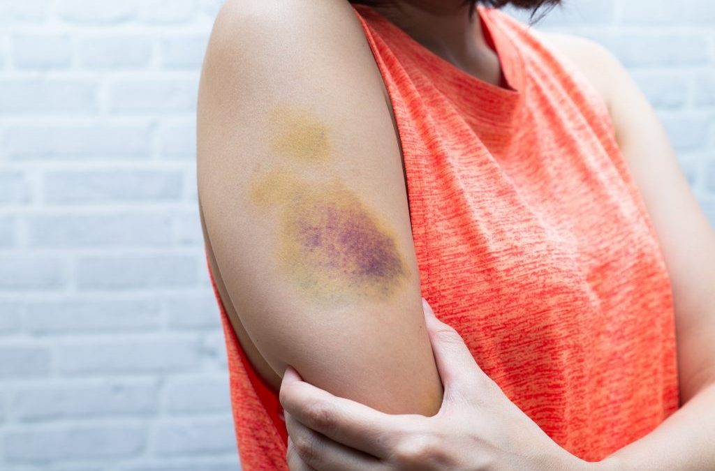 Vânătăi fără motiv? Semnal de alarmă! Ce boli ascund