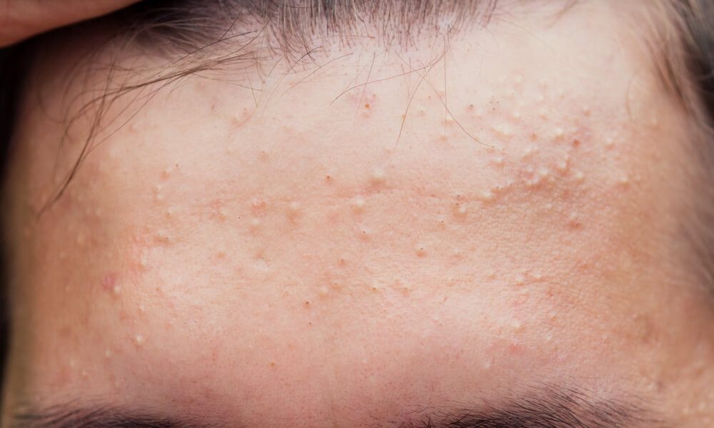 Acid salicilic: protocol anti-acnee în 3 pași. Ghid complet (P)