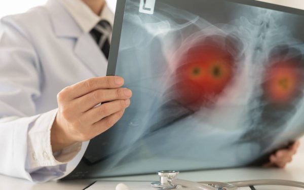 Plămâni Fostului Fumător: Ce Le Păstrează Vulnerabili