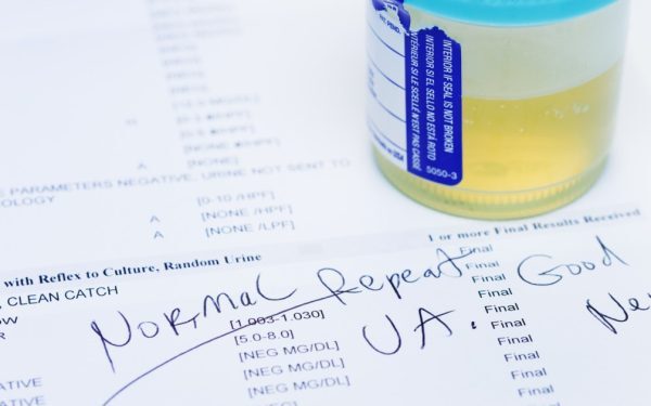 Test de urină: 90% din cancerul vezicii, detectat