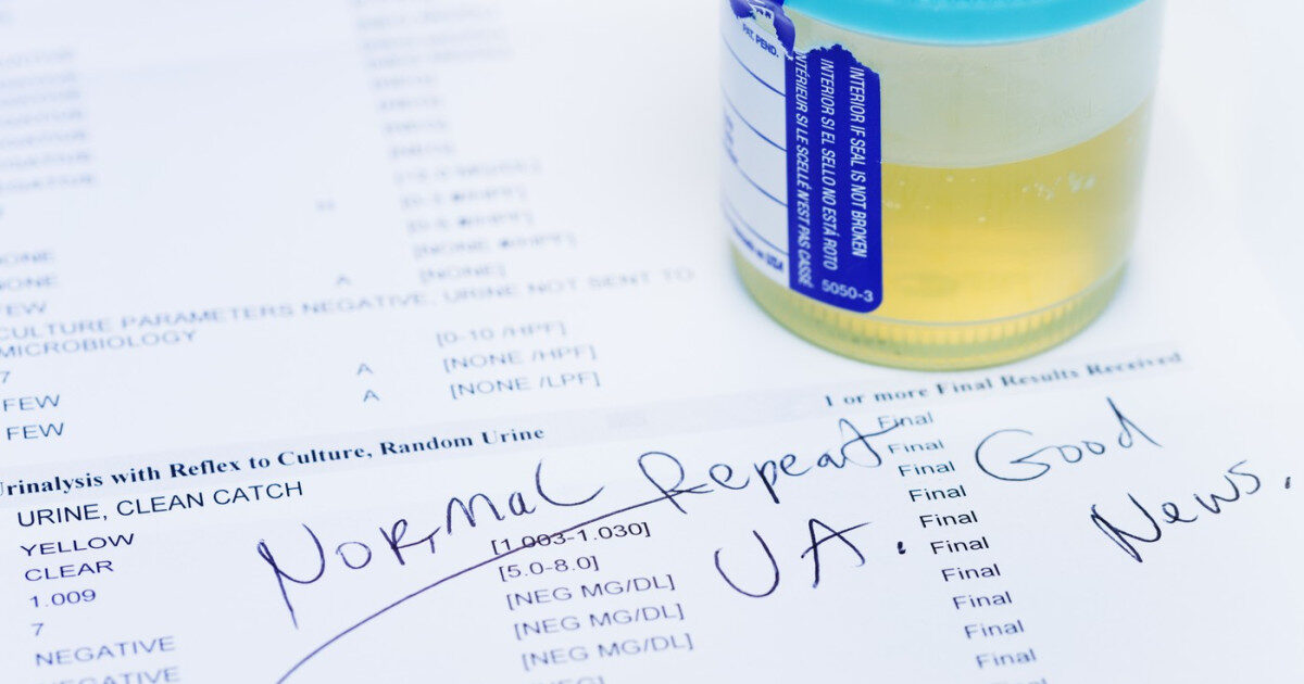 Test de urină: 90% din cancerul vezicii, detectat