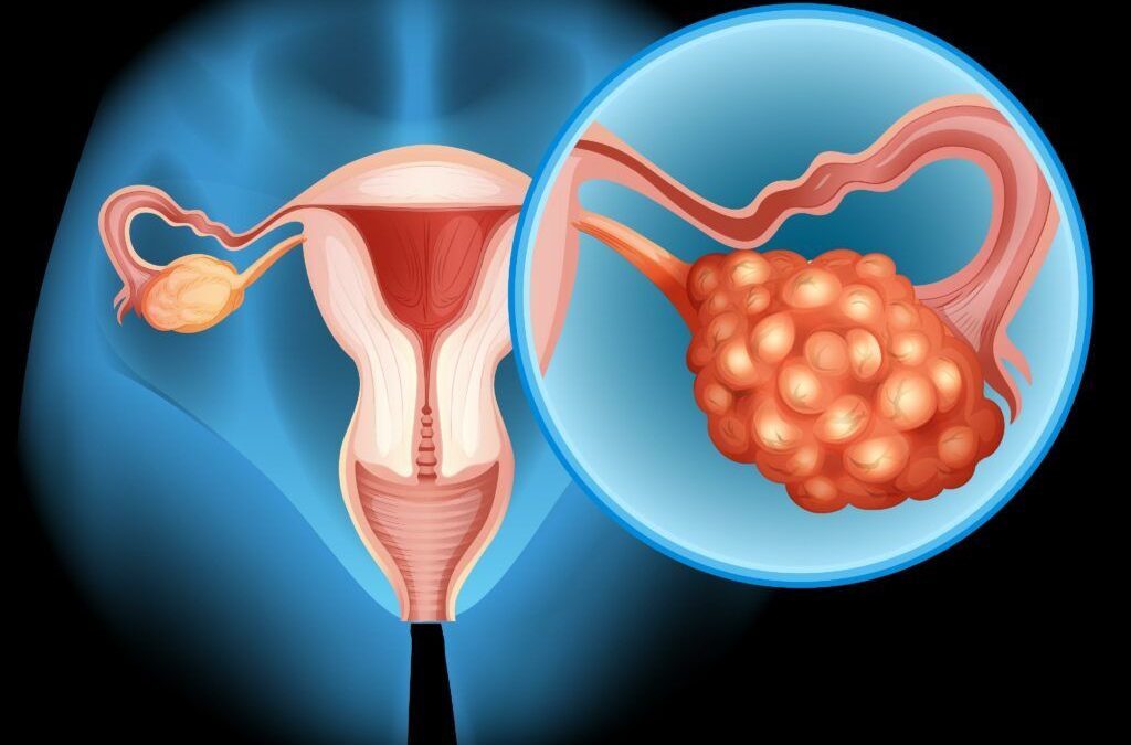 Fructoza accelerează cancerul ovarian și metastazele